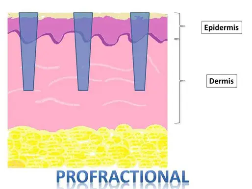 Desen care ilustrează modul în care ProFractional pătrunde în epidermă